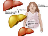 کبد چرب چیست درمان طبیعی و گیاهی آن را بدانید